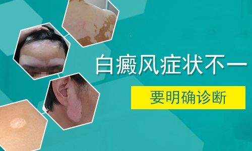 白癜风的症状表现有哪些